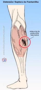 CLÍNICA DECKERS - Distensão da Musculatura da Panturrilha