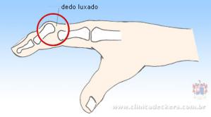 CLÍNICA DECKERS - Luxação do Dedo